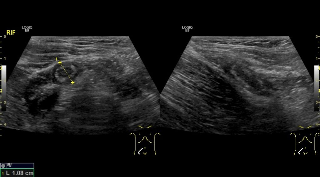 Apendix Target. Sign Basics techniques needed to evaluate the Appendix! – Integrated ...